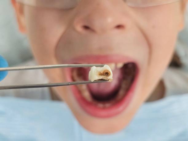 Best Teeth Whitening  in Malvern, IA